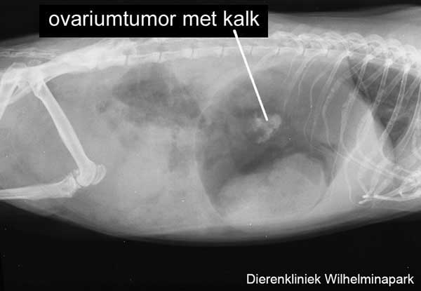 Op de rontgenfoto is een ovariumtumor te zien.